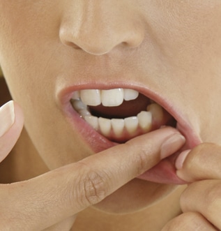 Cum să previi și să tratezi aftele și micile răni bucale